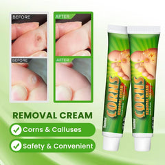 Foot Corns Removal Cream
